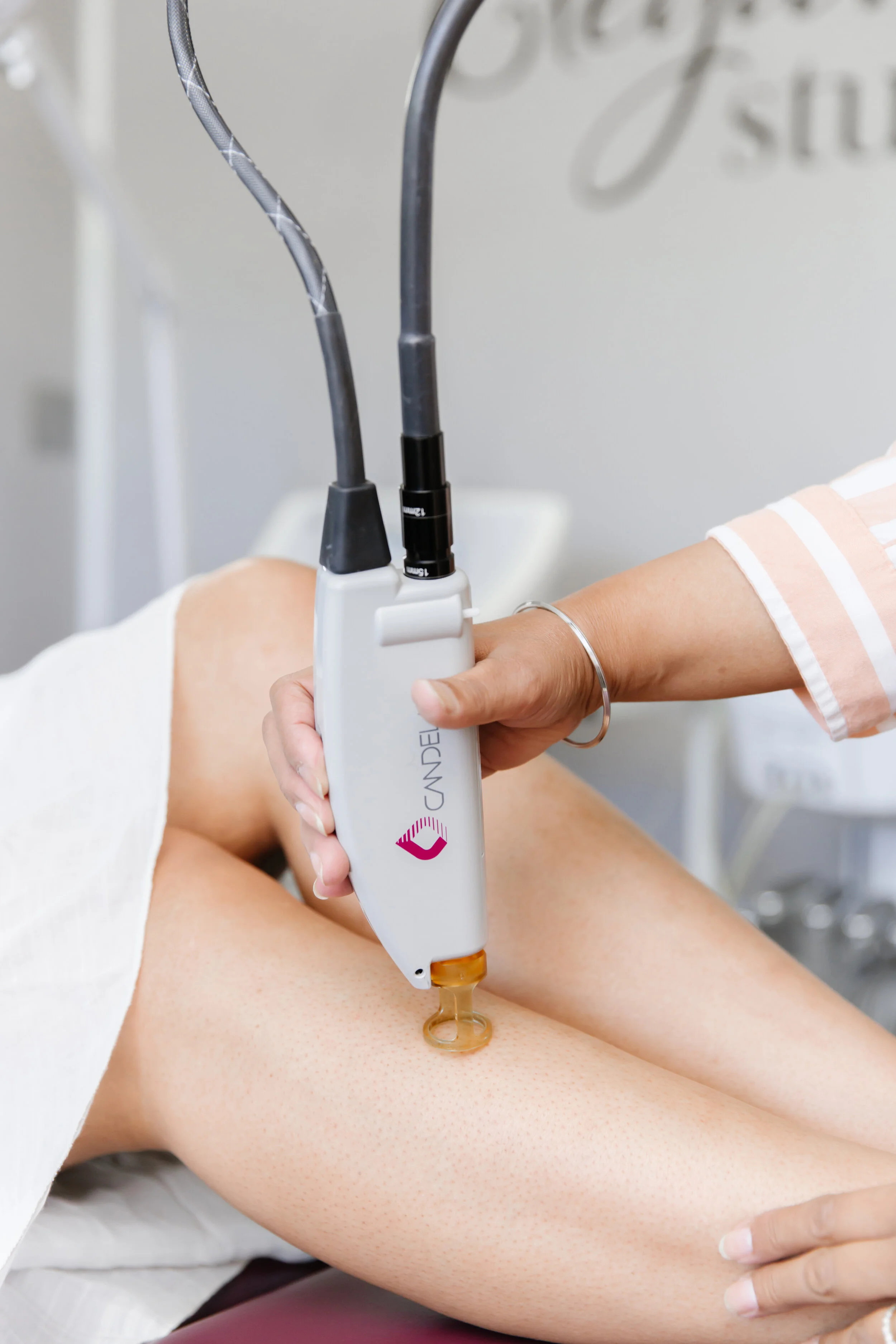 Laser hair removal treatment
